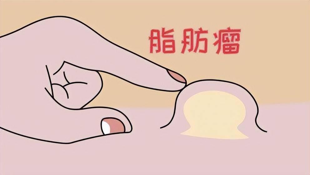 皮下“小汤圆”会癌变吗？